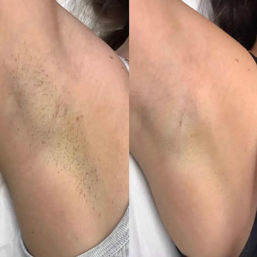 Armpits Transformation