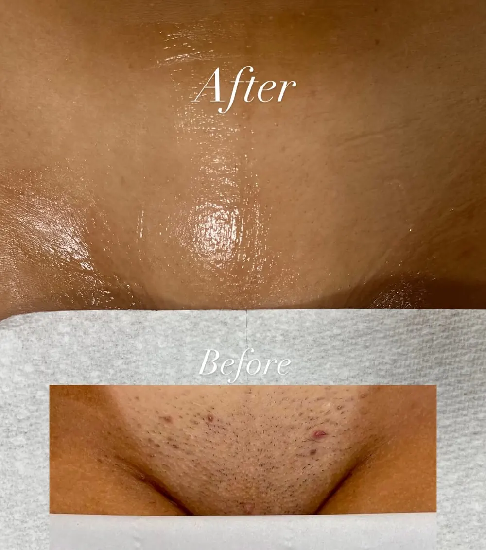 Bikini — After Treatment