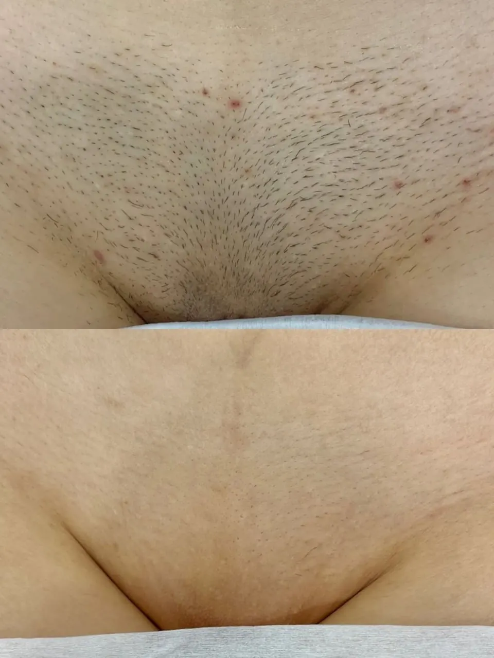Bikini — Smooth & Clear